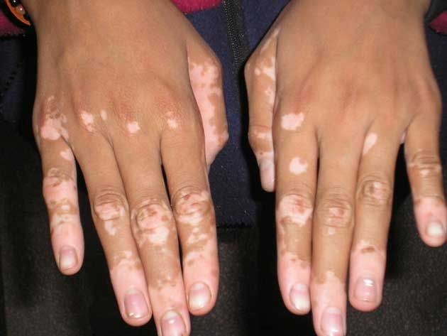 VITILIGO SURGERY (GRAFTING, MELANOTRANSFER)